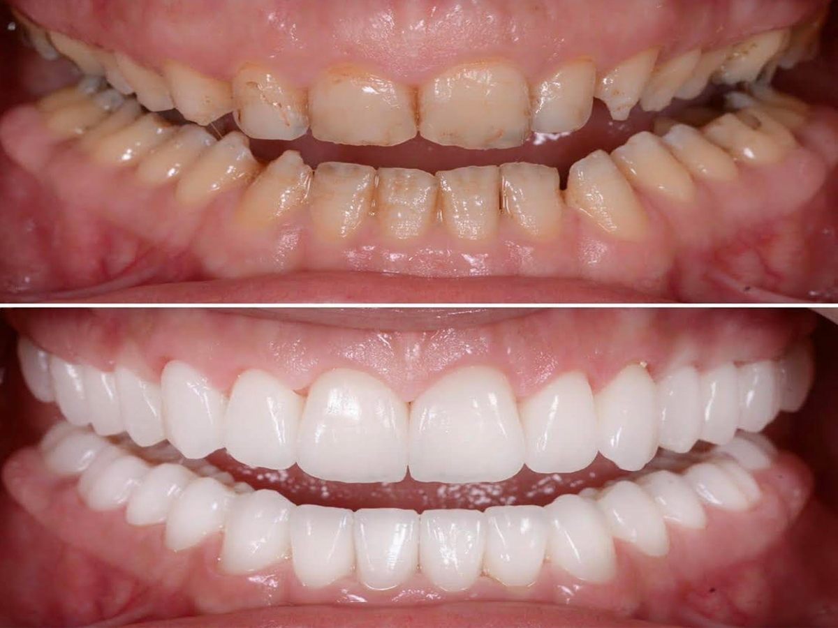 Dentures