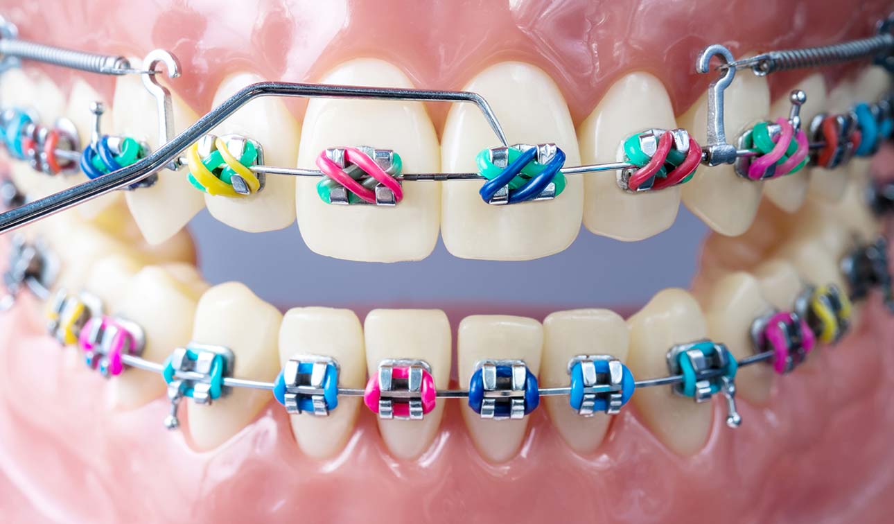 Braces In Charlotte Nc Orthodontist